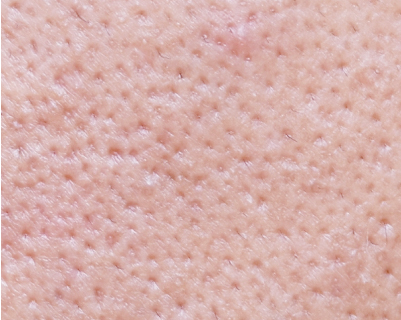 毛穴の黒ずみをなくしたい