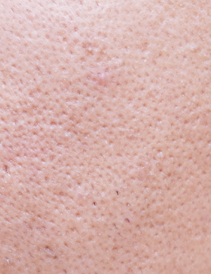 毛穴の黒ずみをなくしたい